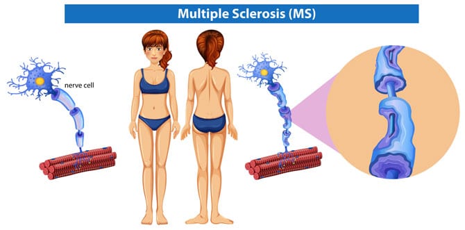 Scleroza în plăci (scleroza multiplă)