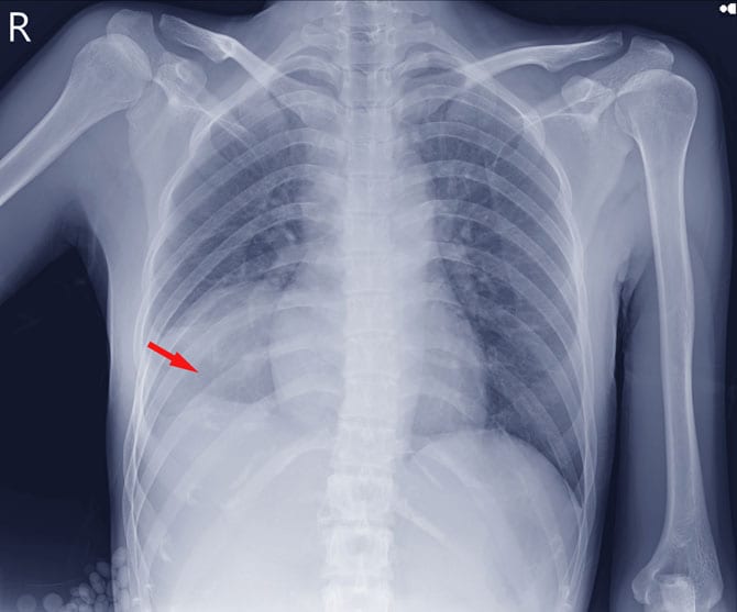 Cordul pulmonar cronic