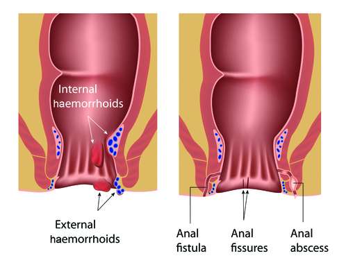Fistula anală - Bolile anorectale